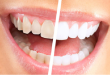 Thói quen chăm sóc răng khiến sức khỏe răng miệng ngày càng tồi tệ