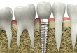 Cấy ghép răng Implant phục hình răng mới như răng thật