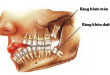 “Bật mí” thông tin răng khôn là gì? Răng khôn có nguy hiểm không?