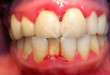 Cách chăm sóc nha chu giúp bạn có hàm răng chắc khỏe.