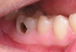 Hàn răng sâu có đau không thưa bác sĩ? – Câu trả lời