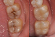 Hàn răng sâu như thế nào? – Quy trình hàn răng sâu