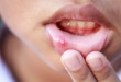 5 Nguyên nhân chính gây bệnh lở miệng mà chắc chắn bạn chưa biết