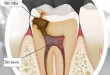 Nguyên nhân và dấu hiệu của viêm tủy răng là gì?