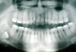 Ý kiến từ chuyên gia: nhổ răng khôn hàm trên có nguy hiểm không?
