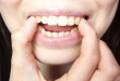 Răng hơi hô có nên niềng không?