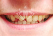 Tại sao phải hàn răng khi răng bị mẻ? Xem ngay tại đây
