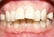 Có nên bọc răng sứ cho răng hô không?