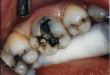 Bệnh viêm tủy răng có chữa được không?