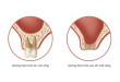 Chuyên gia phân tích: Tiêu xương răng có sao không?