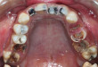 Những điều cần biết về hàn sâu răng