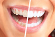 Các cách làm trắng răng hiệu quả  trắng bóng sau 5 phút