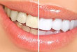 Cách làm trắng răng hiệu quả bất ngờ bằng 8 mẹo nhỏ