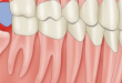 Răng khôn mọc trong bao lâu- Và nhổ răng khôn như thế nào