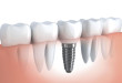 Những trường hợp nào nên cấy răng implant?