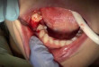 Nhổ răng sâu có ảnh hưởng gì không và quy trình nhổ răng tại nha khoa