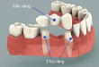 Có nên làm cầu răng không khi bị mất răng hàm ?