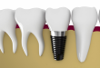 Cấy ghép răng Implant hay làm cầu răng sứ?