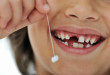 Những câu hỏi xung quanh nhổ răng trẻ em
