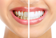 Tẩy trắng răng giá bao nhiêu là hợp lý nhất hiện nay?