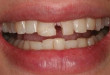 Những dạng tổn thương của răng