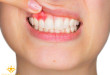 Chăm sóc răng bị viêm lợi – Chữa như thế nào? <<< XEM NGAY