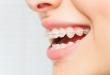 Video chăm sóc răng niềng – Chuyên gia bật mí chế độ chăm sóc CHUẨN