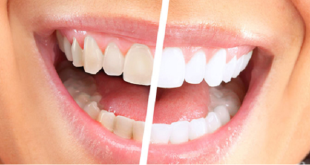 Cách làm trắng răng nhanh nhất hiệu quả ngoài mong đợi 