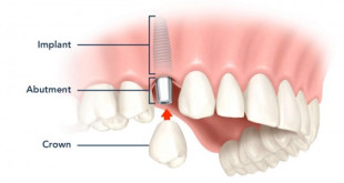 Bọc răng sứ có đau không? – Giải pháp làm răng hot nhất 2018
