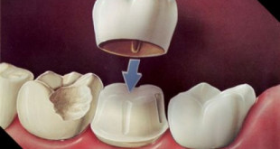 Thắc mắc xung quanh vấn đề có nên bọc răng sứ không? – BS giải đáp