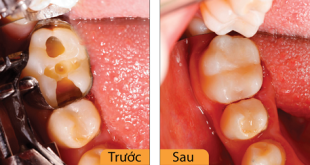 Nha khoa điều trị tủy răng tốt nhất tại Hà Nội?