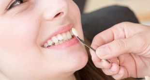Tổng hợp những kiến thức nhất định phải biết cho người muốn làm răng sứ