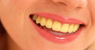 Răng bị ố vàng nguyên nhân & những điều cần biết