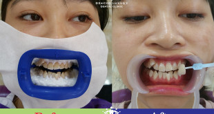 Tẩy trắng răng CN Zoom White Perfect – Răng sáng, rạng nụ cười