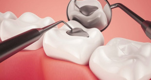 Trám răng là gì và cách thực hiện như thế nào?
