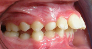 3 nguyên nhân gây răng vẩu và hướng khắc phục