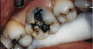 Bị sâu răng phải làm sao điều trị tận gốc (Chuyên gia tư vấn)