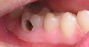 Hàn răng sâu có đau không thưa bác sĩ? – Câu trả lời