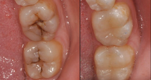 Hàn răng sâu như thế nào? – Quy trình hàn răng sâu