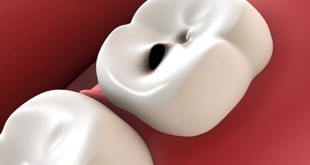 Lời khuyên chuyên gia dành cho bạn: Có nên hàn răng không?
