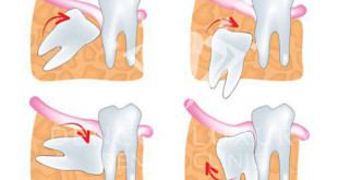 Nhổ răng số 8 có ảnh hưởng gì không? – Nguy hiểm nếu ko xem bài này