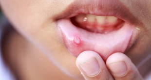 Nguyên nhân gây bệnh lở miệng và cách chữa lở miệng hiệu quả