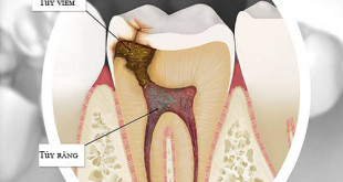 Nguyên nhân và dấu hiệu của viêm tủy răng là gì?