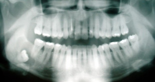 Ý kiến từ chuyên gia: nhổ răng khôn hàm trên có nguy hiểm không?