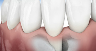 Những biến chứng và cách hạn chế tiêu xương ổ răng