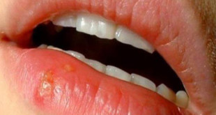 Những triệu chứng bệnh lở miệng và lưu ý mà bạn chưa biết