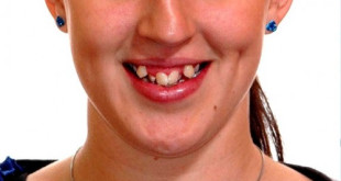 Niềng răng 1 hàm có được không? – BS nha khoa giải đáp