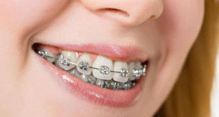 Niềng răng để làm gì? – Chuyên gia nha khoa quốc tế