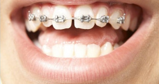Niềng răng thưa mất bao lâu thời gian? – Chi phí niềng răng 2018