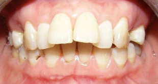Răng bị hô phải làm sao? Cách điều trị hiệu quả nhất là gì?